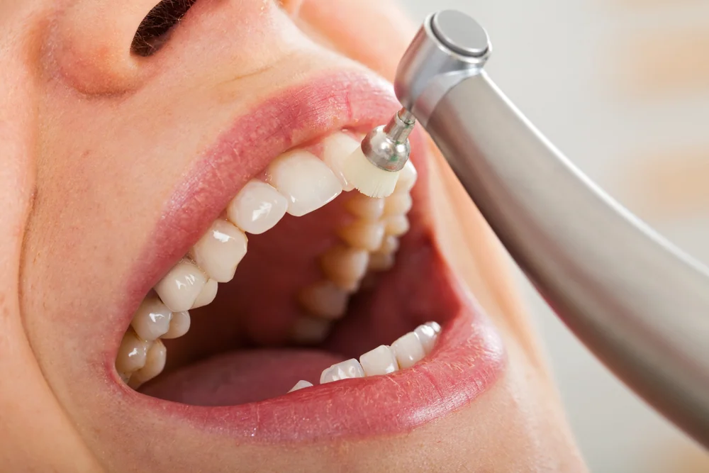 Fluoride Treatment Calgary