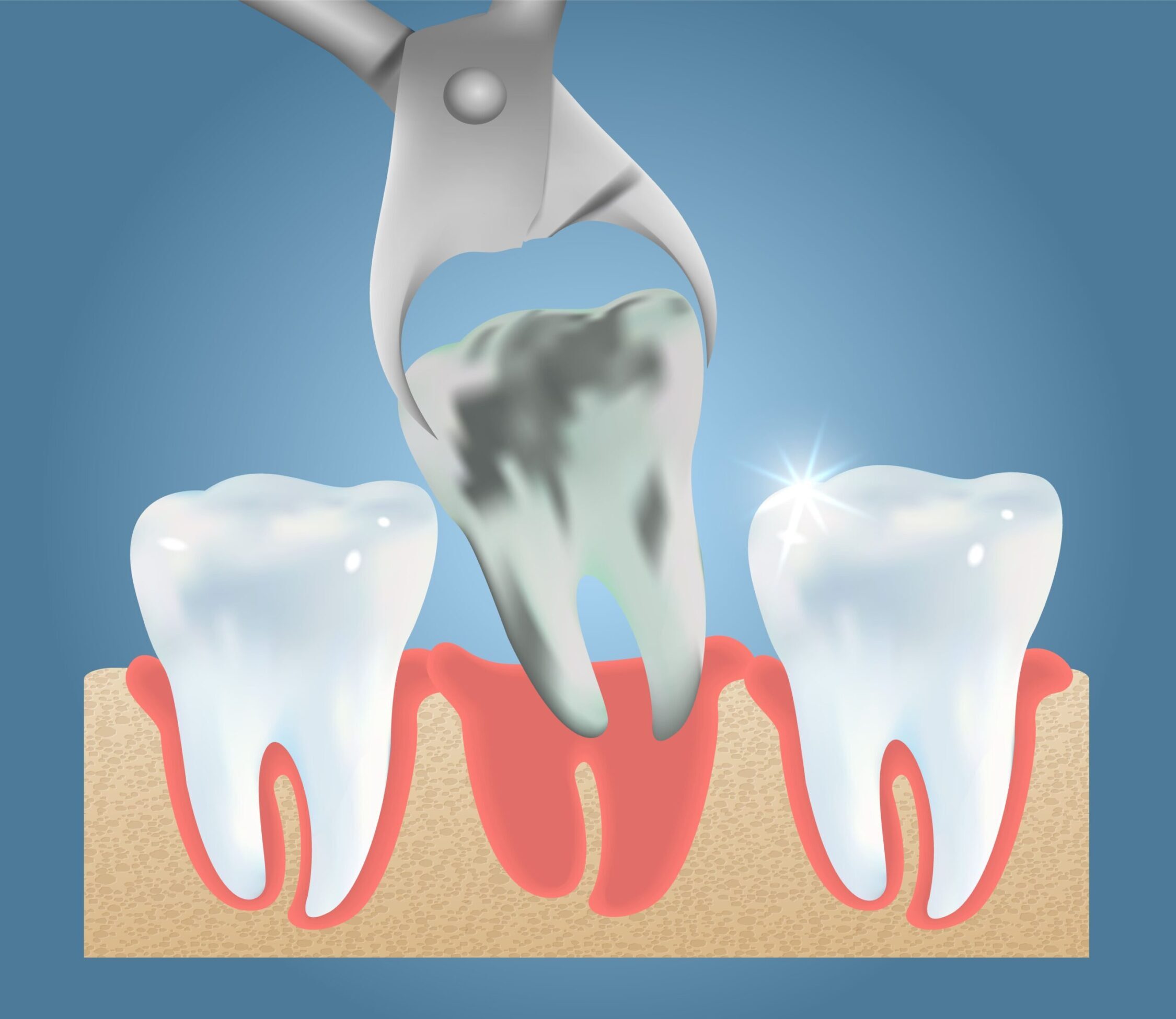 Tooth Extractions Calgary
